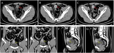 Primary urachal leiomyosarcoma: a case report and literature review of clinical, pathological, and medical imaging features